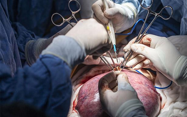 Realizan en IMSS cirugía fetal para corregir espina bífida